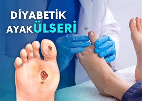 Diyabet Hastaları için Nemlendirici Bakım